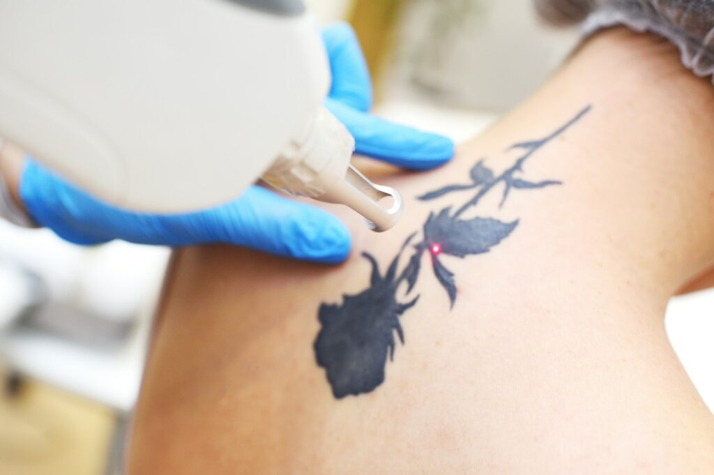 How the Option to Remove Tattoos Affects the Tattoo Industry